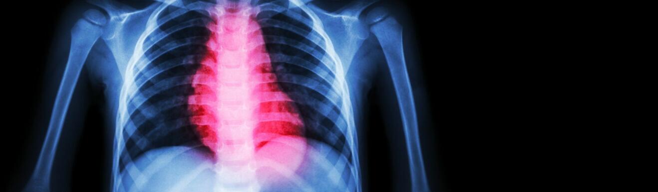 SNM News ¦Prise en charge de l’infarctus de type NSTEMI en 2021 – qu’en est-il dans le canton ? - N°104