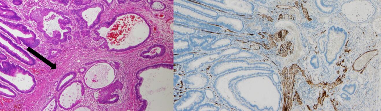SNM News ¦ Programme de dépistage du cancer colique BEJUNEt - N°104